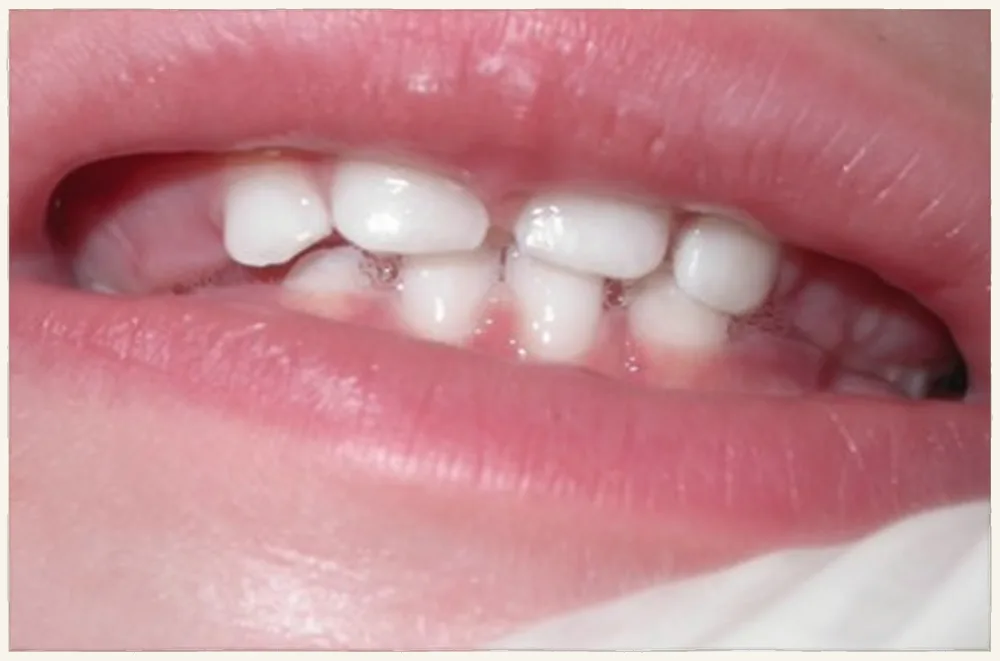 Guia incisal estabelecida
